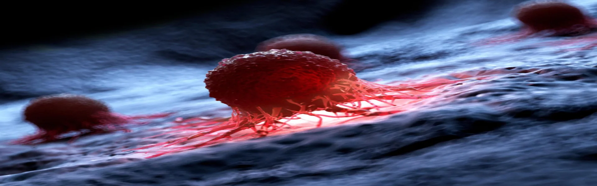 Wilms Tumor